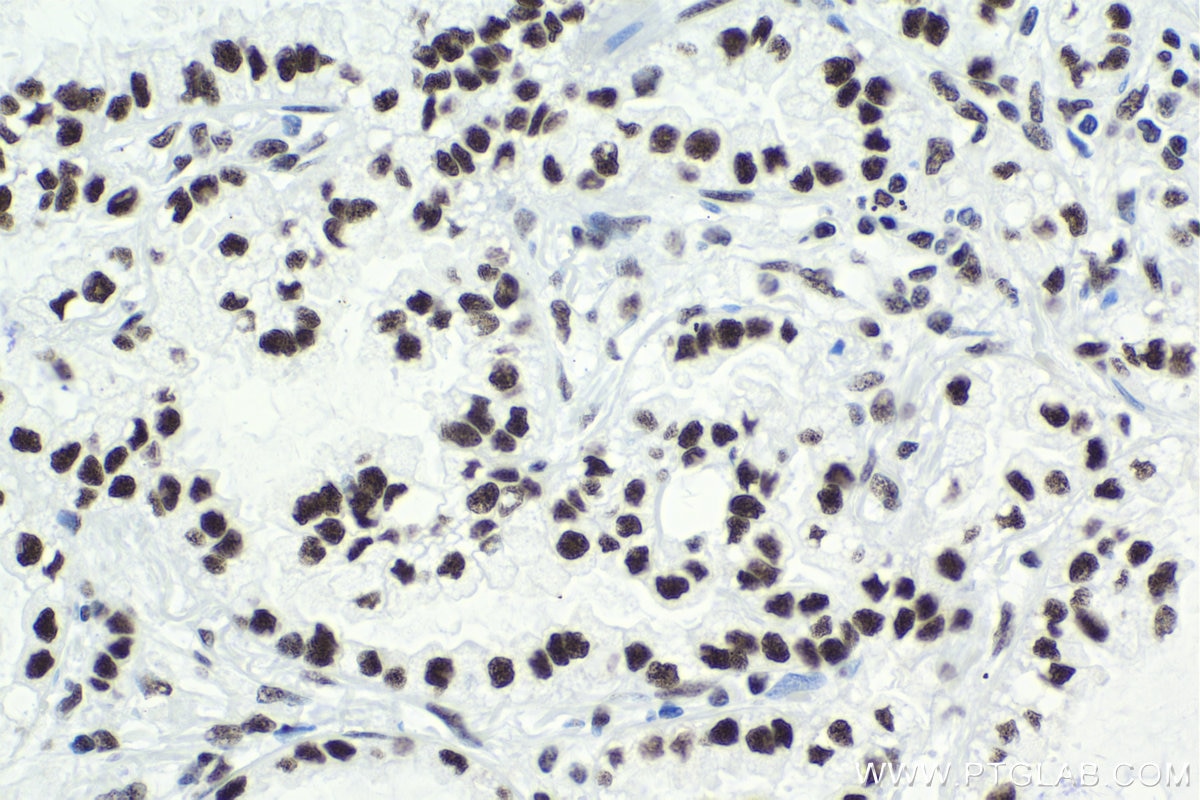 Immunohistochemistry (IHC) staining of human lung cancer tissue using SF3B3 Polyclonal antibody (14577-1-AP)