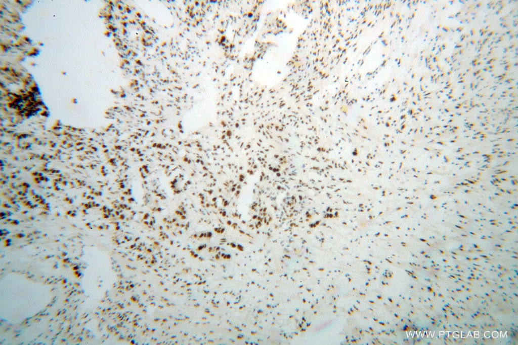 Immunohistochemistry (IHC) staining of human gliomas tissue using SF3B3 Polyclonal antibody (14577-1-AP)
