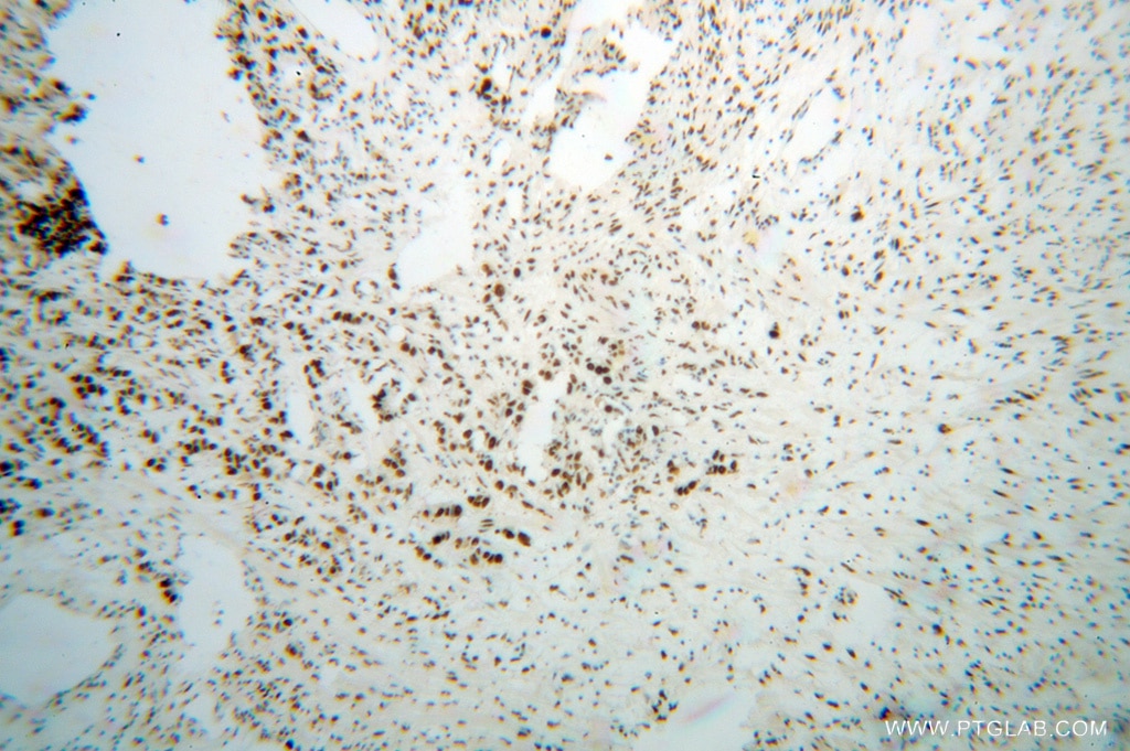 IHC staining of human gliomas using 14577-1-AP