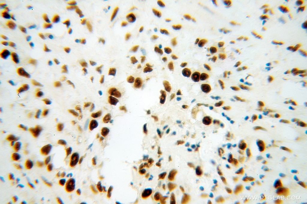 Immunohistochemistry (IHC) staining of human gliomas tissue using SF3B3 Polyclonal antibody (14577-1-AP)