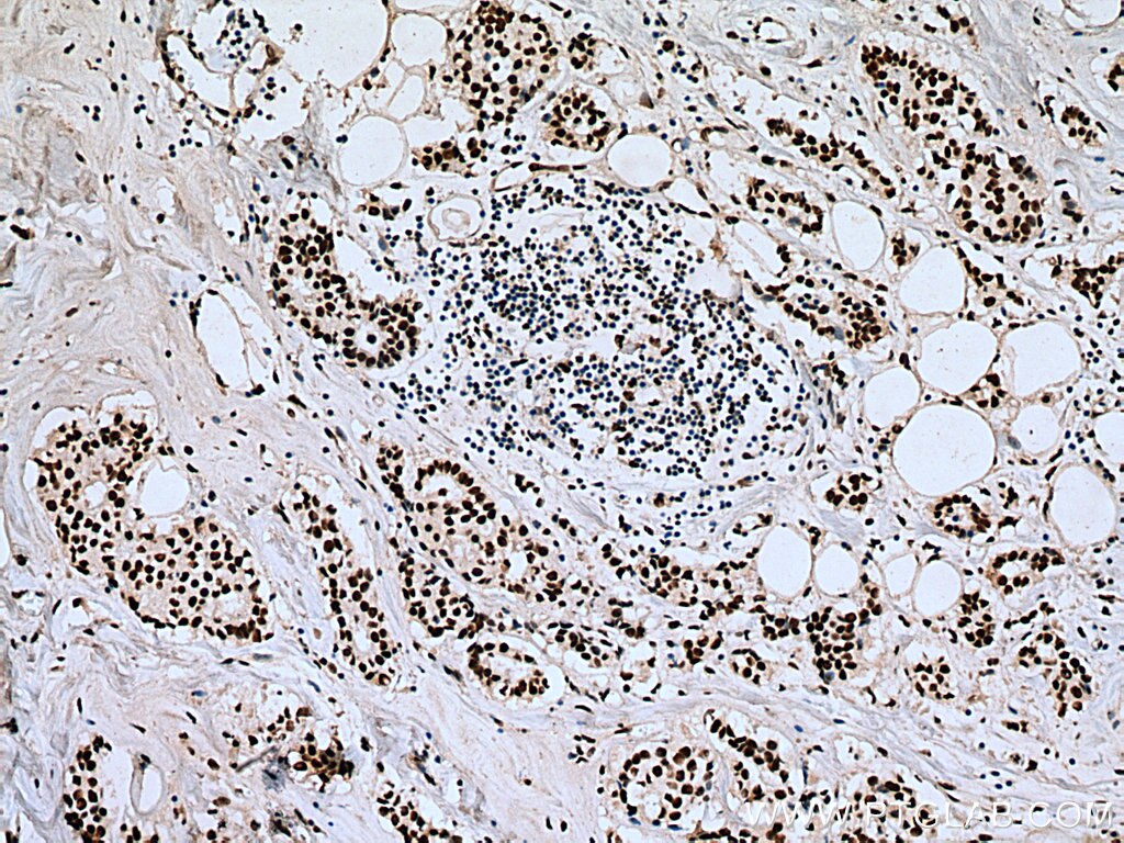 Immunohistochemistry (IHC) staining of human breast cancer tissue using SF3B3 Monoclonal antibody (67469-1-Ig)