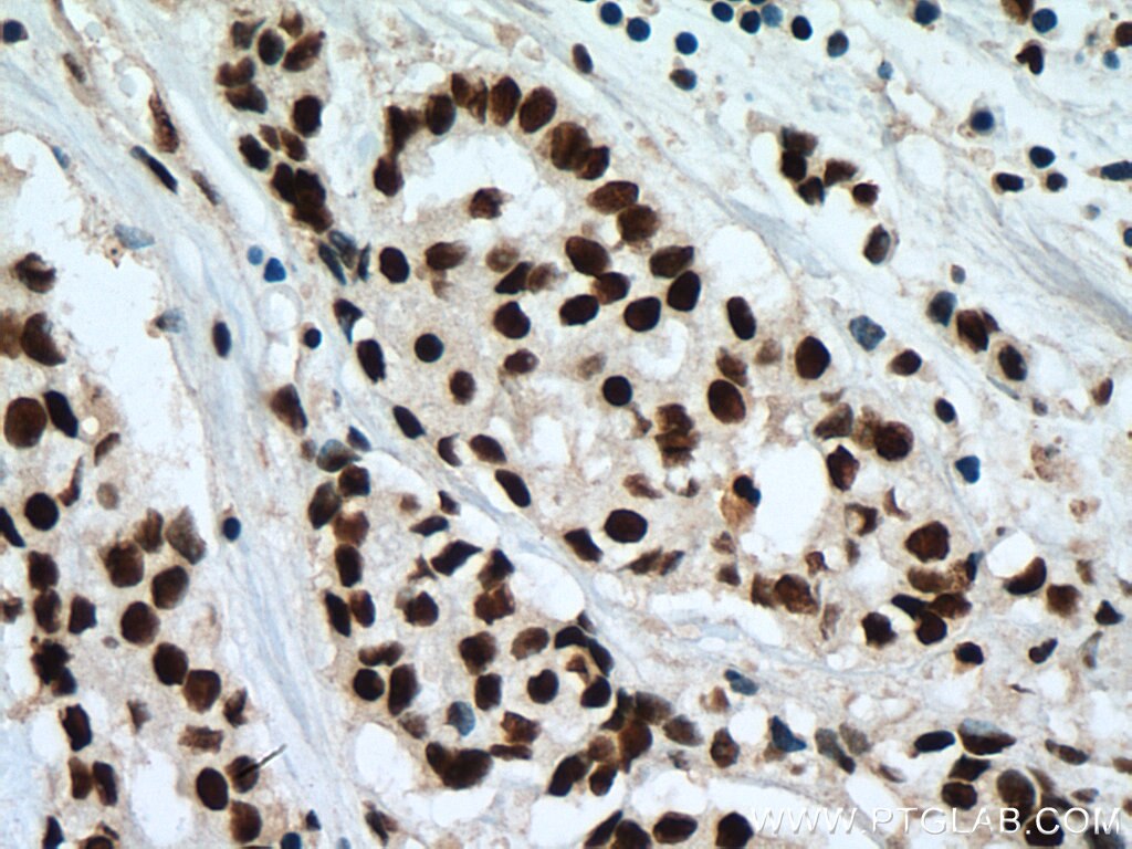 Immunohistochemistry (IHC) staining of human breast cancer tissue using SF3B3 Monoclonal antibody (67469-1-Ig)