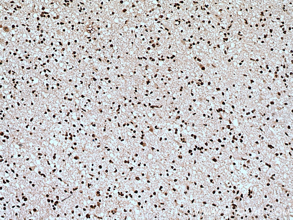 Immunohistochemistry (IHC) staining of human gliomas tissue using SF3B3 Monoclonal antibody (67469-1-Ig)