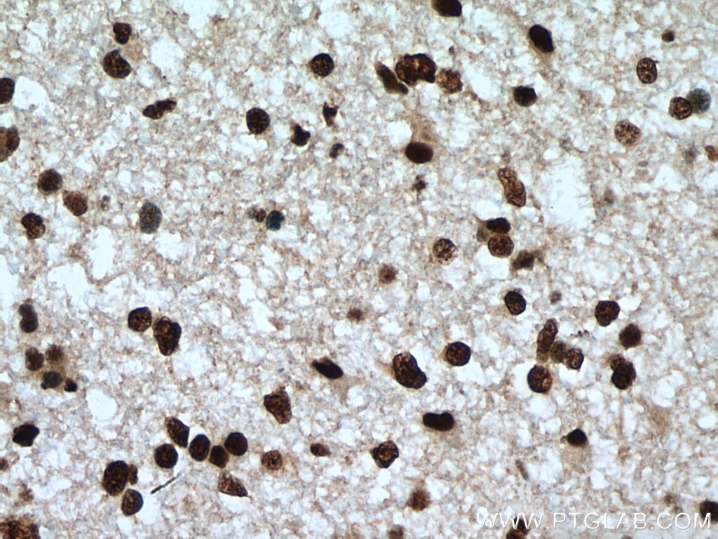 Immunohistochemistry (IHC) staining of human gliomas tissue using SF3B3 Monoclonal antibody (67469-1-Ig)