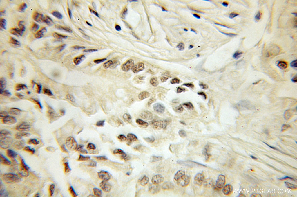 IHC staining of human pancreas cancer using 10482-1-AP