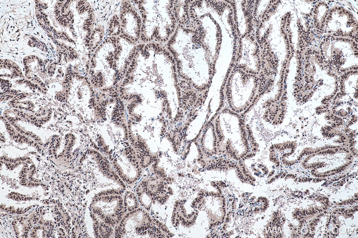 Immunohistochemistry (IHC) staining of human ovary tumor tissue using SF3B5 Polyclonal antibody (15525-1-AP)