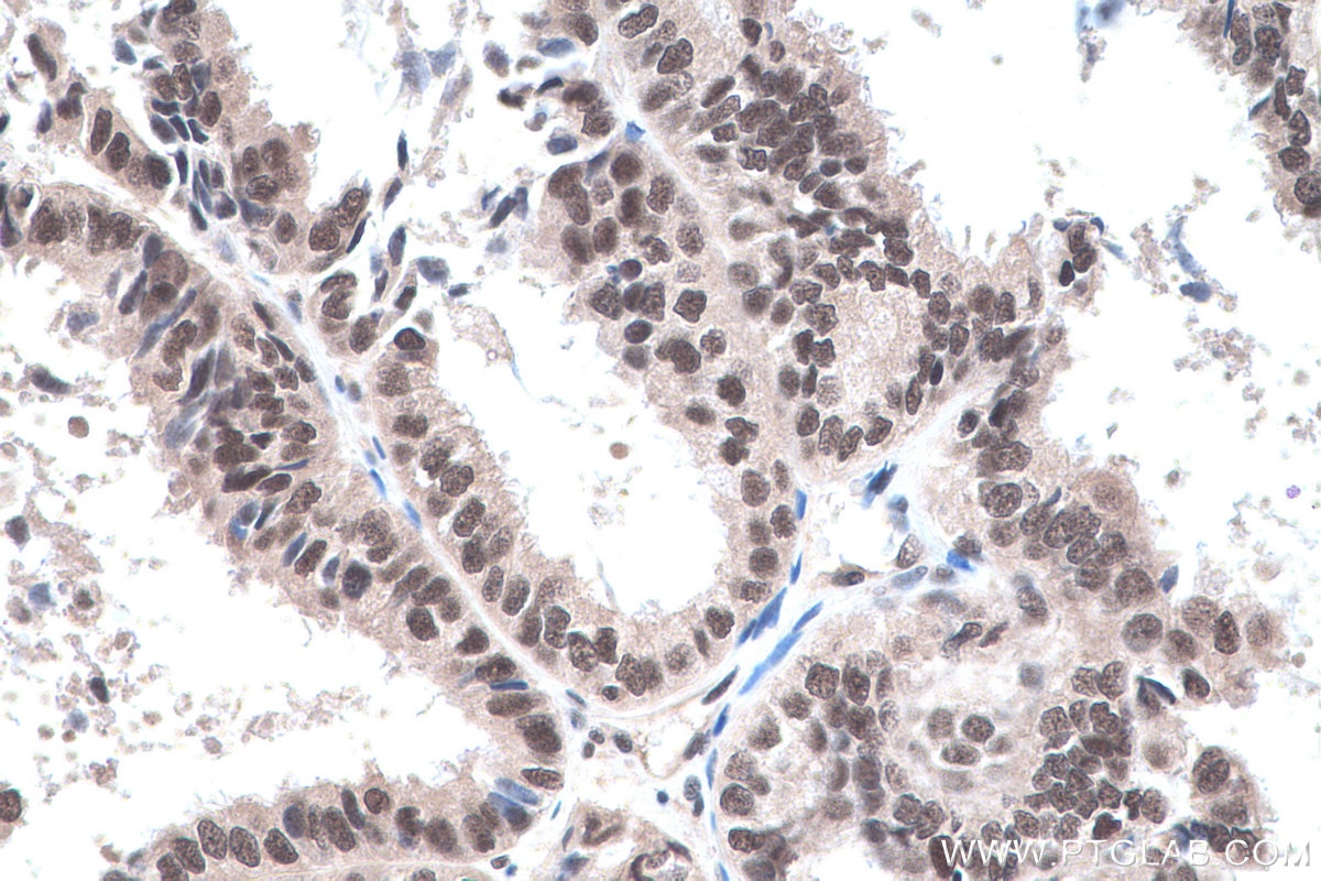 Immunohistochemistry (IHC) staining of human ovary tumor tissue using SF3B5 Polyclonal antibody (15525-1-AP)