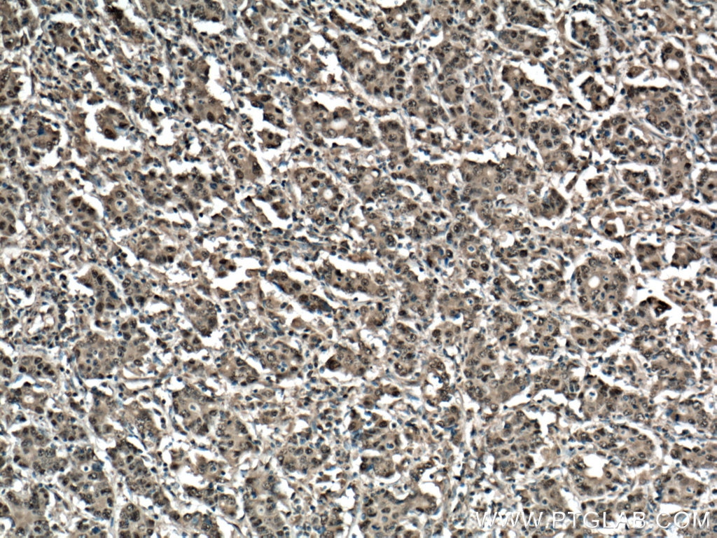 Immunohistochemistry (IHC) staining of human stomach cancer tissue using 14-3-3 Sigma Polyclonal antibody (10622-1-AP)