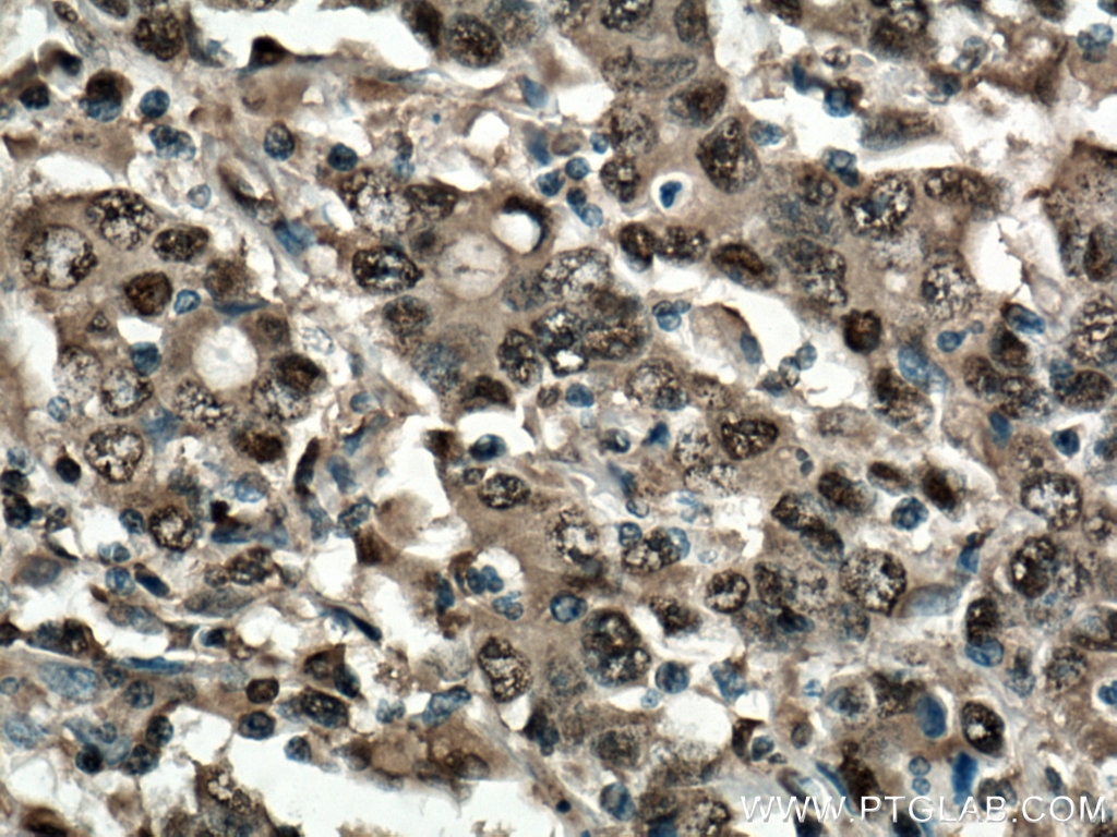 Immunohistochemistry (IHC) staining of human stomach cancer tissue using 14-3-3 Sigma Polyclonal antibody (10622-1-AP)