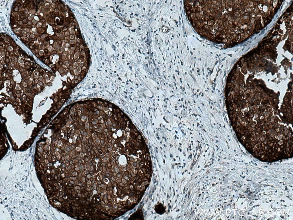 Immunohistochemistry (IHC) staining of human breast cancer tissue using 14-3-3 Sigma Monoclonal antibody (66251-1-Ig)