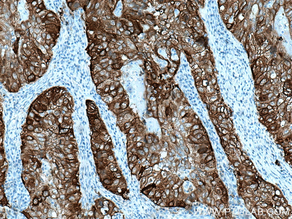 Immunohistochemistry (IHC) staining of human lung cancer tissue using 14-3-3 Sigma Monoclonal antibody (66251-1-Ig)