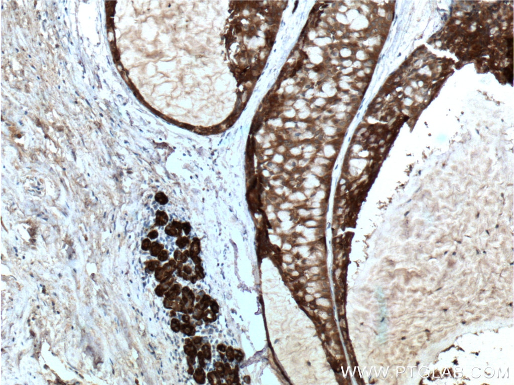 IHC staining of human breast hyperplasia using 66251-1-Ig