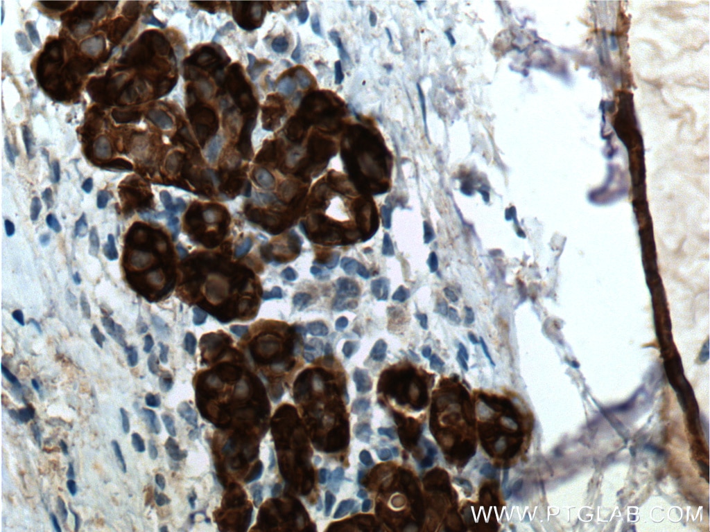 Immunohistochemistry (IHC) staining of human breast hyperplasia tissue using 14-3-3 Sigma Monoclonal antibody (66251-1-Ig)