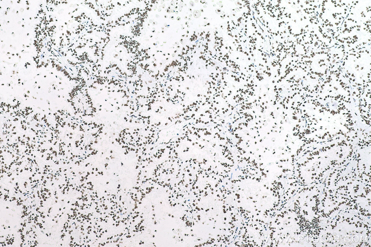 Immunohistochemistry (IHC) staining of human lung cancer tissue using SFPQ Monoclonal antibody (67129-1-Ig)