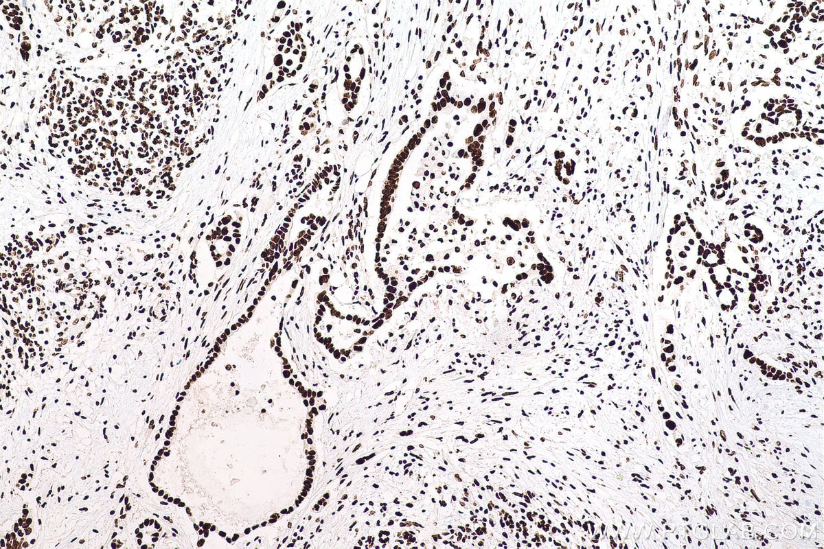Immunohistochemistry (IHC) staining of human pancreas cancer tissue using SFPQ Monoclonal antibody (67129-1-Ig)