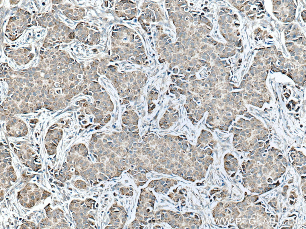 Immunohistochemistry (IHC) staining of human breast cancer tissue using SFRP1 Polyclonal antibody (26460-1-AP)