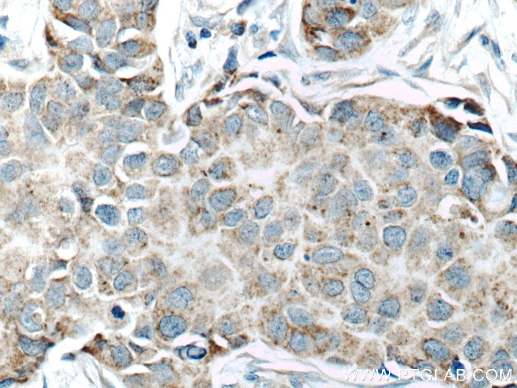 Immunohistochemistry (IHC) staining of human breast cancer tissue using SFRP1 Polyclonal antibody (26460-1-AP)