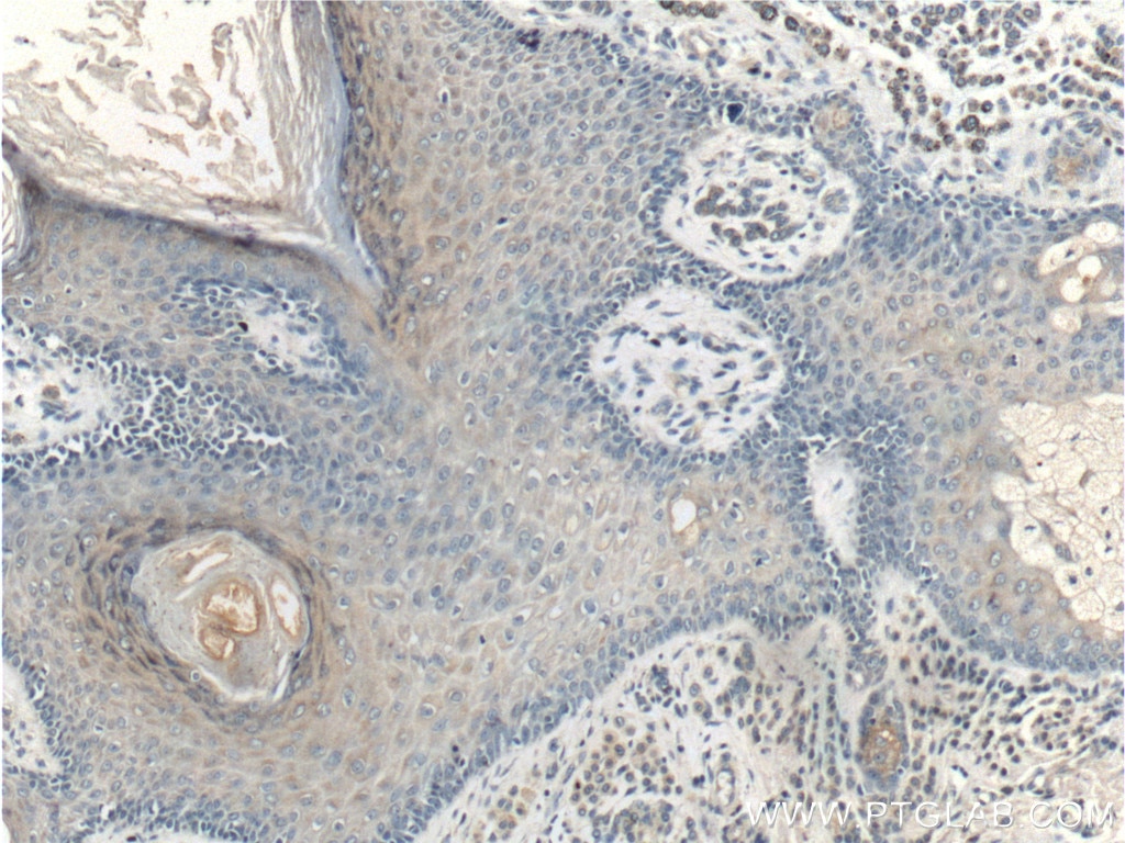 Immunohistochemistry (IHC) staining of human malignant melanoma tissue using SFRP2 Monoclonal antibody (66328-1-Ig)