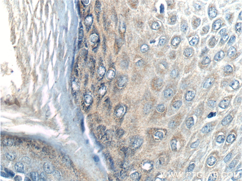 Immunohistochemistry (IHC) staining of human malignant melanoma tissue using SFRP2 Monoclonal antibody (66328-1-Ig)