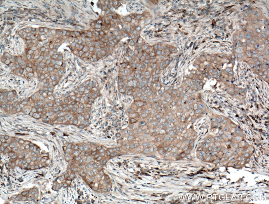 Immunohistochemistry (IHC) staining of human breast cancer tissue using SFRP4 Polyclonal antibody (15328-1-AP)