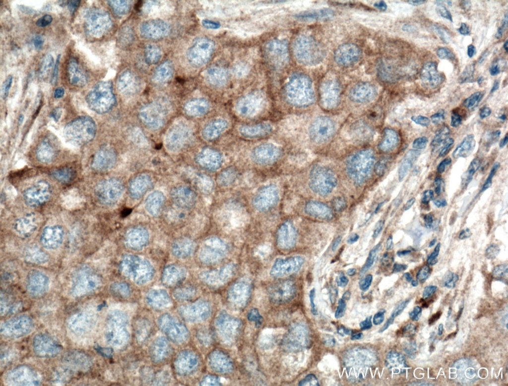Immunohistochemistry (IHC) staining of human breast cancer tissue using SFRP4 Polyclonal antibody (15328-1-AP)