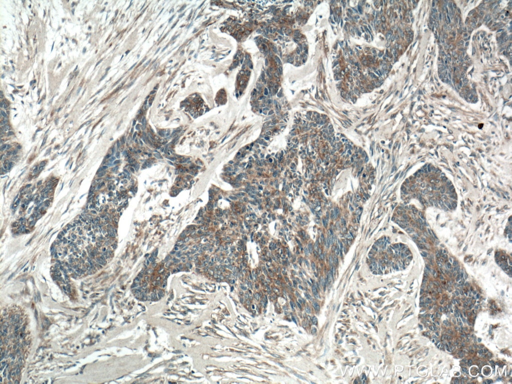 Immunohistochemistry (IHC) staining of human skin cancer tissue using SFRP4 Polyclonal antibody (15328-1-AP)