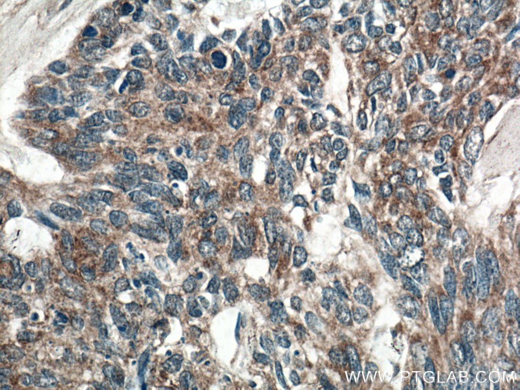 Immunohistochemistry (IHC) staining of human skin cancer tissue using SFRP4 Polyclonal antibody (15328-1-AP)