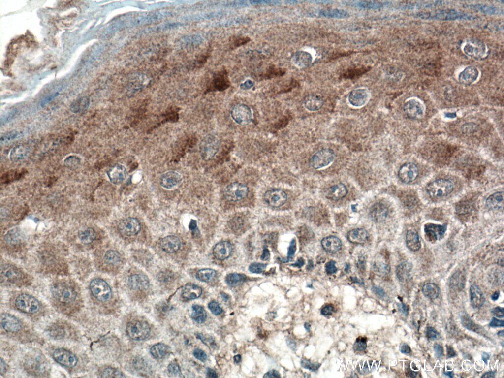 Immunohistochemistry (IHC) staining of human skin cancer tissue using SFRP4 Polyclonal antibody (15328-1-AP)