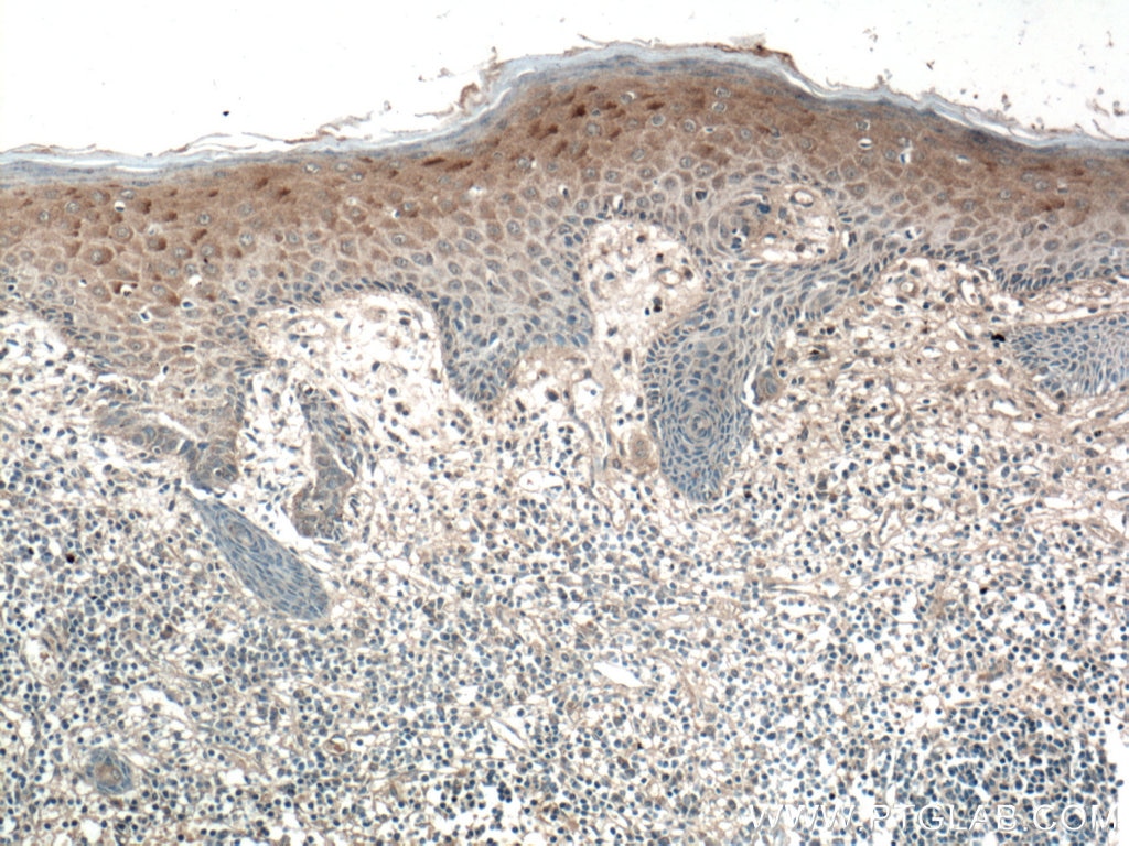 IHC staining of human skin cancer using 15328-1-AP