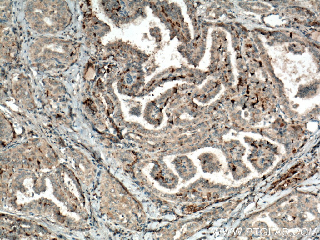 Immunohistochemistry (IHC) staining of human thyroid cancer tissue using SFRP5 Polyclonal antibody (14283-1-AP)