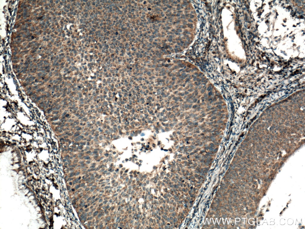 Immunohistochemistry (IHC) staining of human cervical cancer tissue using SFRP5 Polyclonal antibody (14283-1-AP)