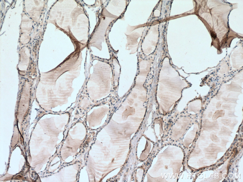 Immunohistochemistry (IHC) staining of human thyroid cancer tissue using SFRP5 Polyclonal antibody (19177-1-AP)