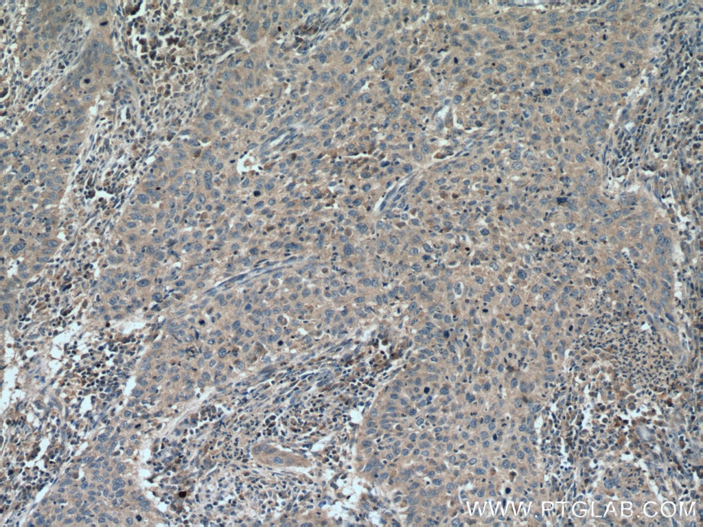 Immunohistochemistry (IHC) staining of human cervical cancer tissue using SFRP5 Polyclonal antibody (19177-1-AP)