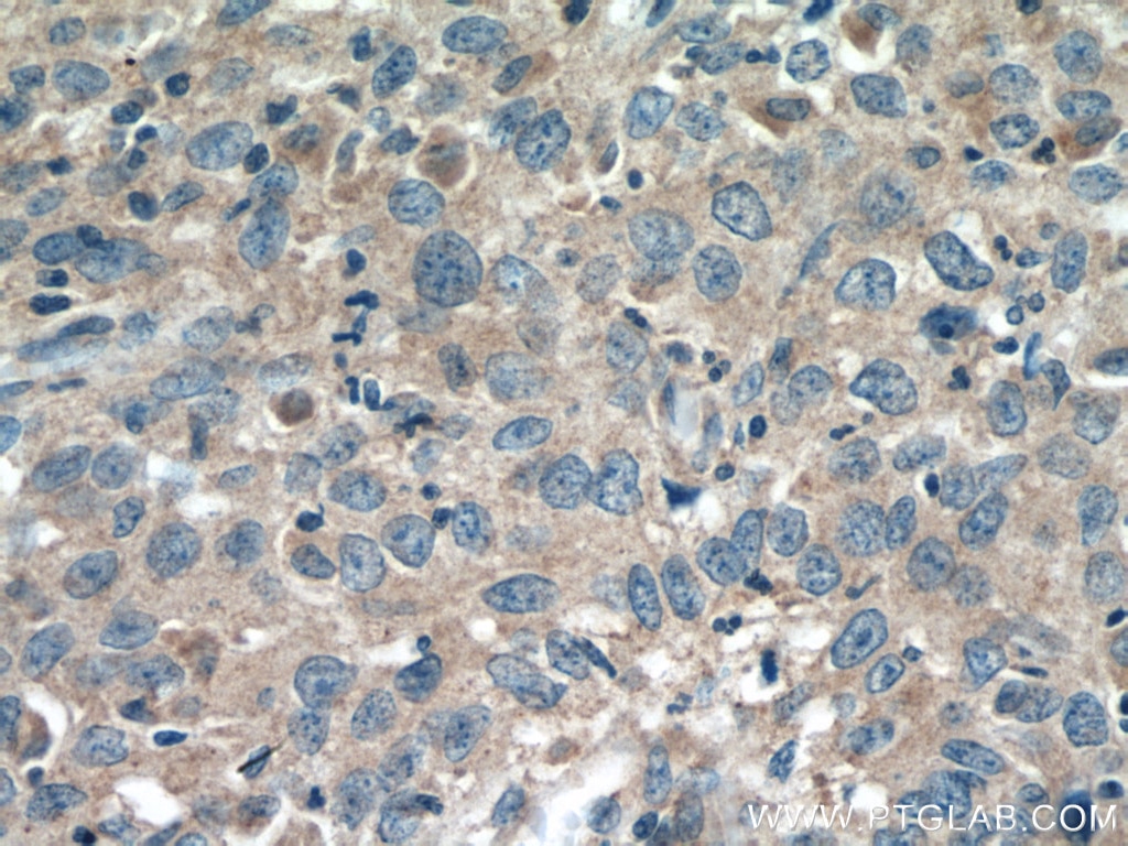Immunohistochemistry (IHC) staining of human cervical cancer tissue using SFRP5 Polyclonal antibody (19177-1-AP)