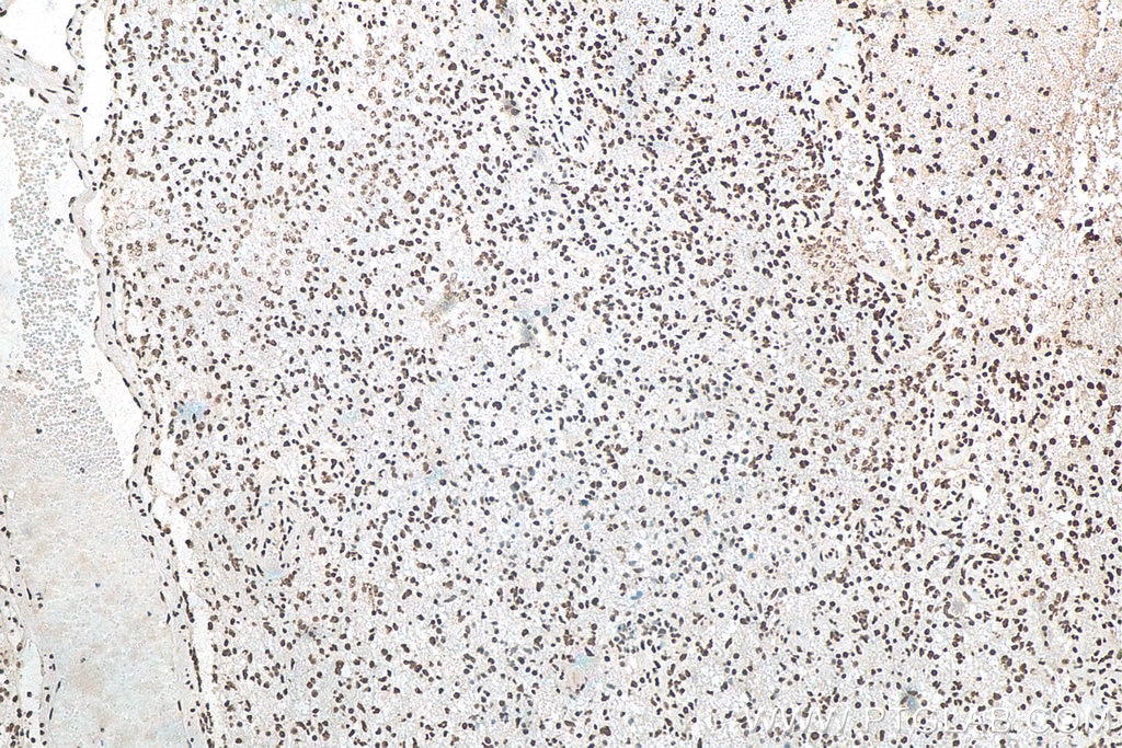 IHC staining of human gliomas using 12929-2-AP