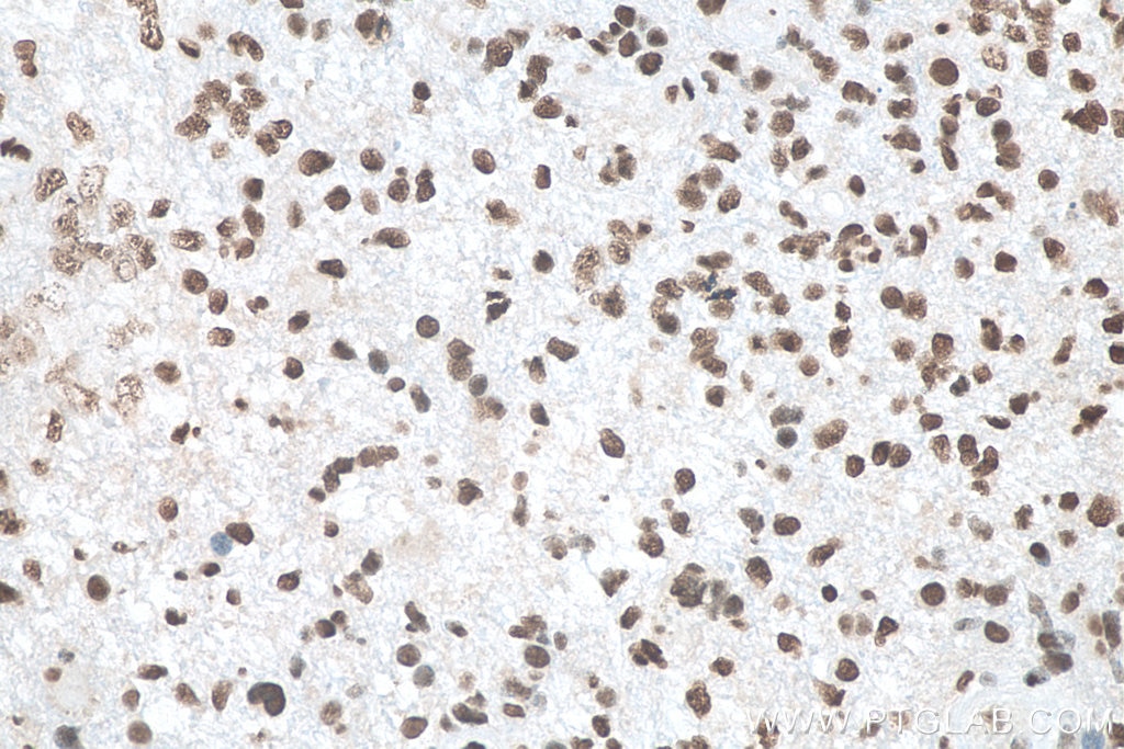 Immunohistochemistry (IHC) staining of human gliomas tissue using ASF/SF2 Polyclonal antibody (12929-2-AP)