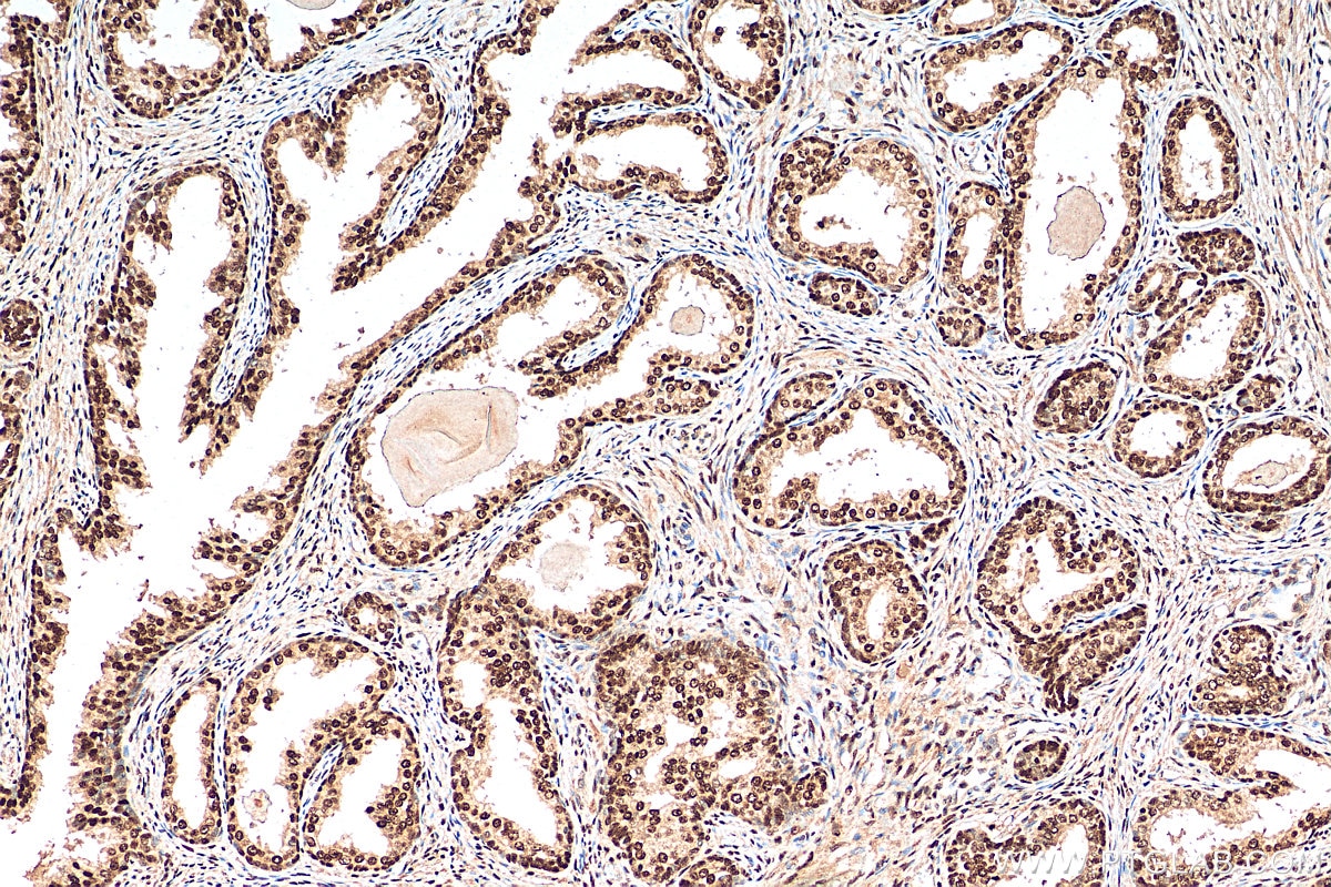 Immunohistochemistry (IHC) staining of human prostate cancer tissue using SFRS14 Polyclonal antibody (12514-1-AP)