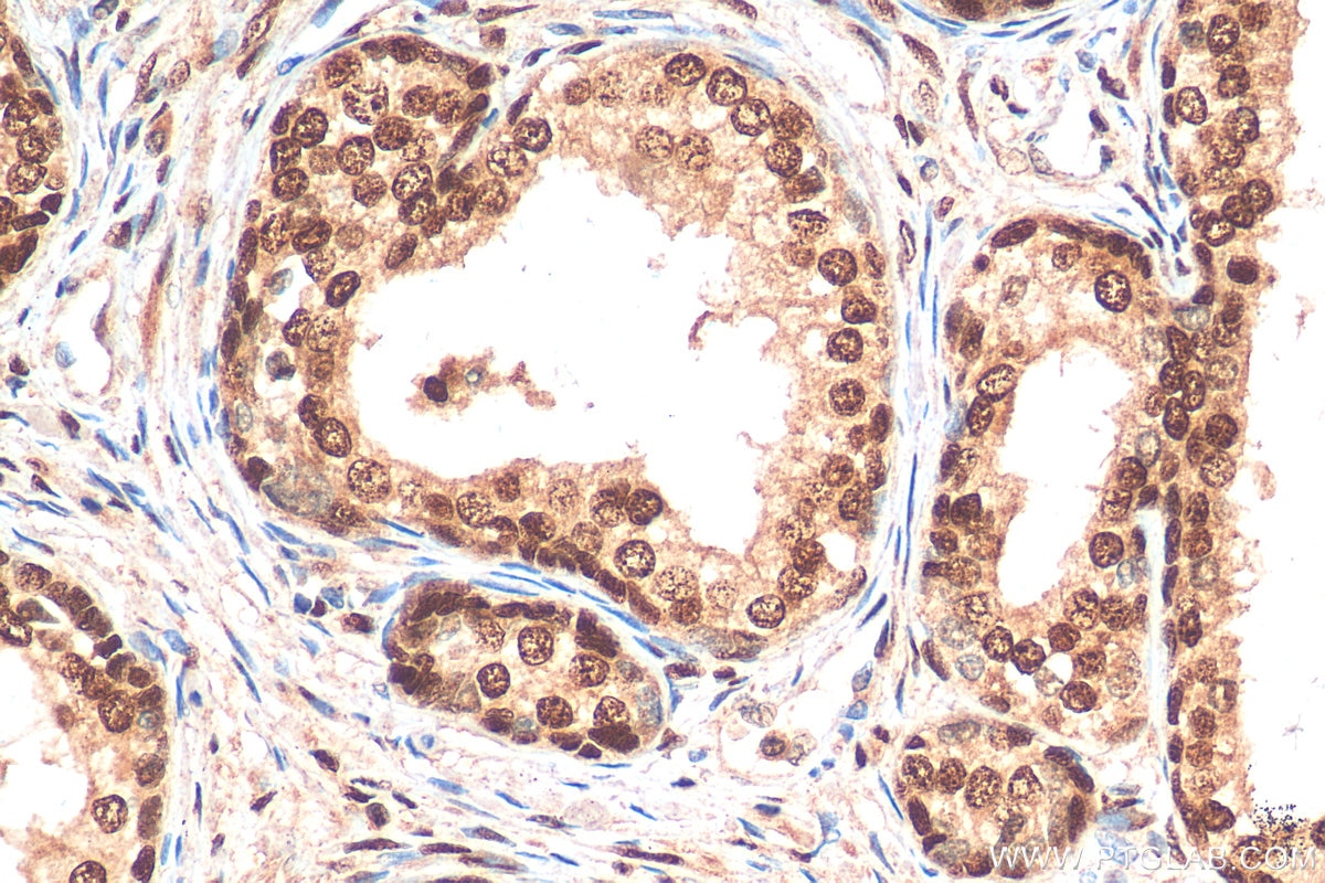 Immunohistochemistry (IHC) staining of human prostate cancer tissue using SFRS14 Polyclonal antibody (12514-1-AP)