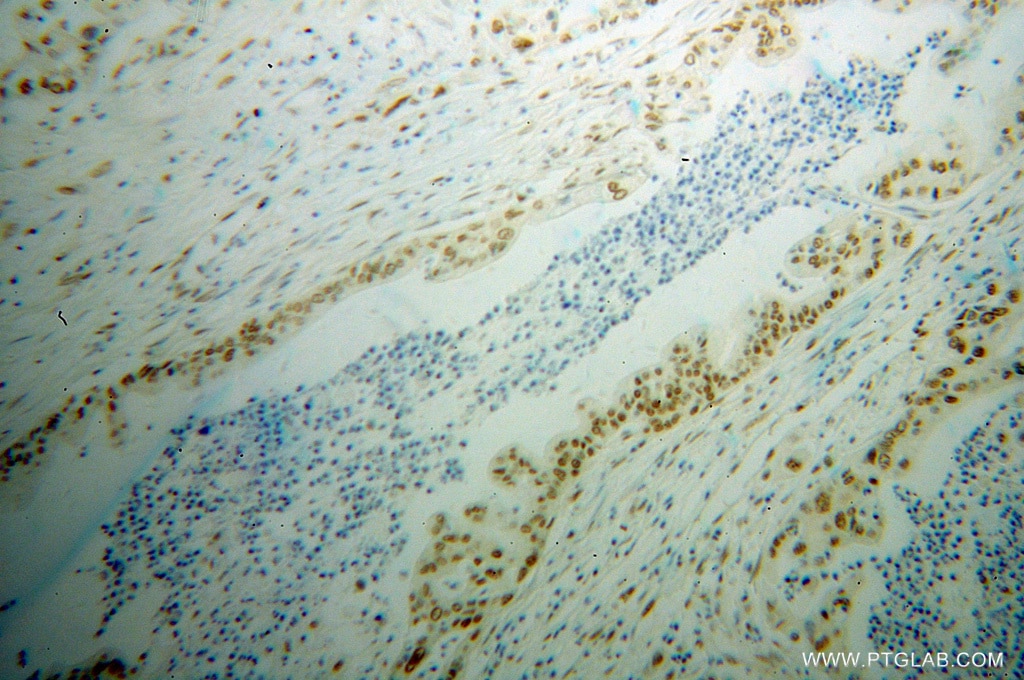Immunohistochemistry (IHC) staining of human pancreas cancer tissue using SFRS17A Polyclonal antibody (13441-1-AP)