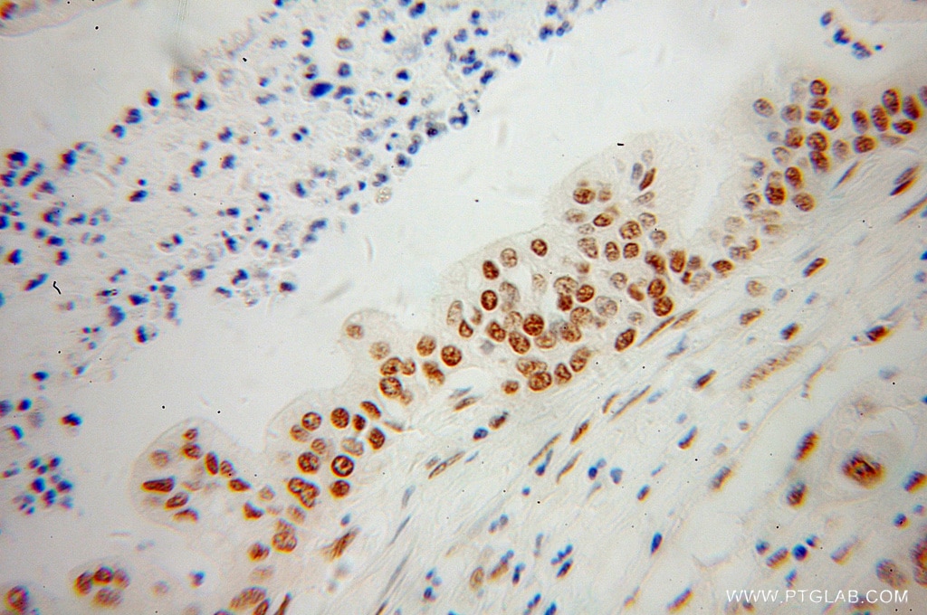 Immunohistochemistry (IHC) staining of human pancreas cancer tissue using SFRS17A Polyclonal antibody (13441-1-AP)