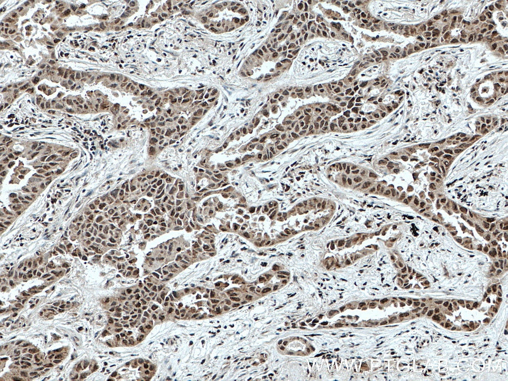 Immunohistochemistry (IHC) staining of human lung cancer tissue using SFRS2 Polyclonal antibody (20371-1-AP)