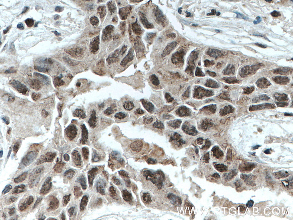 Immunohistochemistry (IHC) staining of human lung cancer tissue using SFRS2 Polyclonal antibody (20371-1-AP)