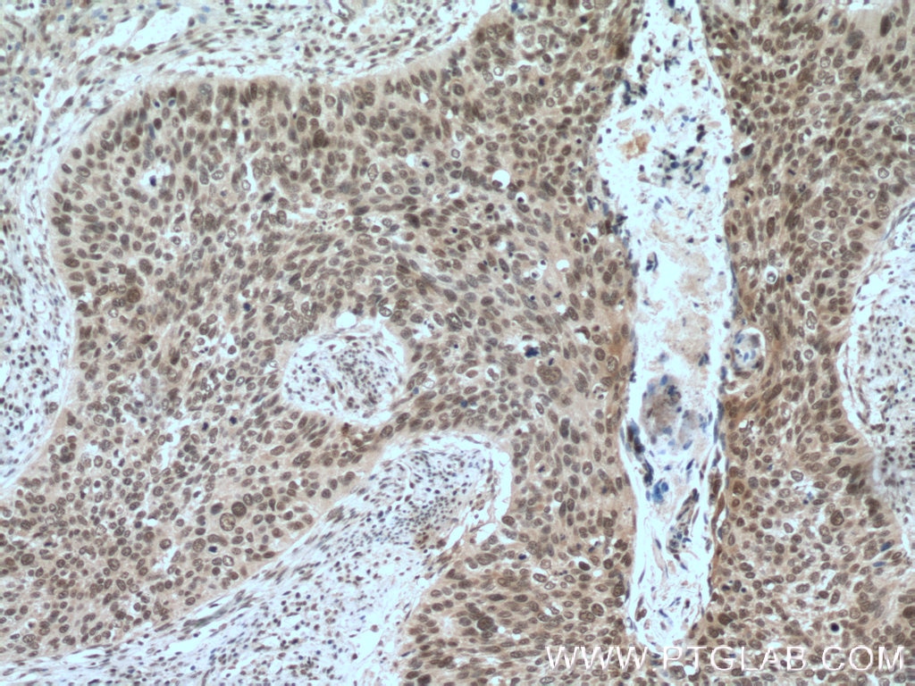 IHC staining of human cervical cancer using 10916-1-AP