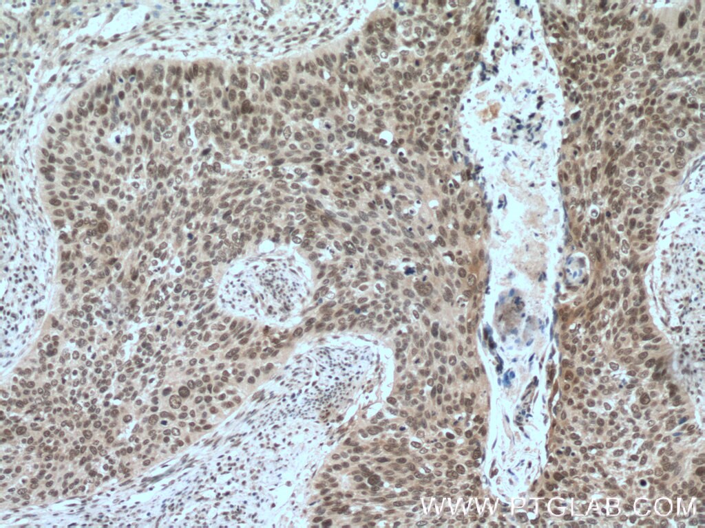 Immunohistochemistry (IHC) staining of human cervical cancer tissue using SRp20 Polyclonal antibody (10916-1-AP)