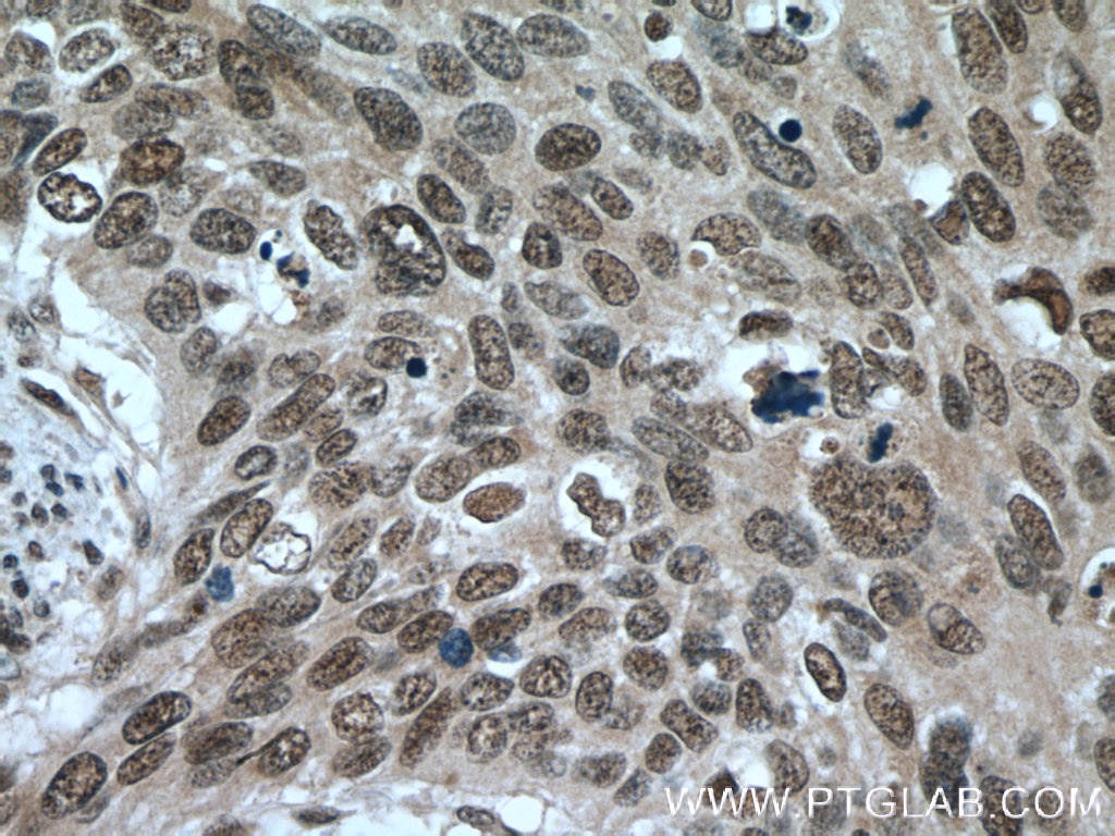 Immunohistochemistry (IHC) staining of human cervical cancer tissue using SRp20 Polyclonal antibody (10916-1-AP)