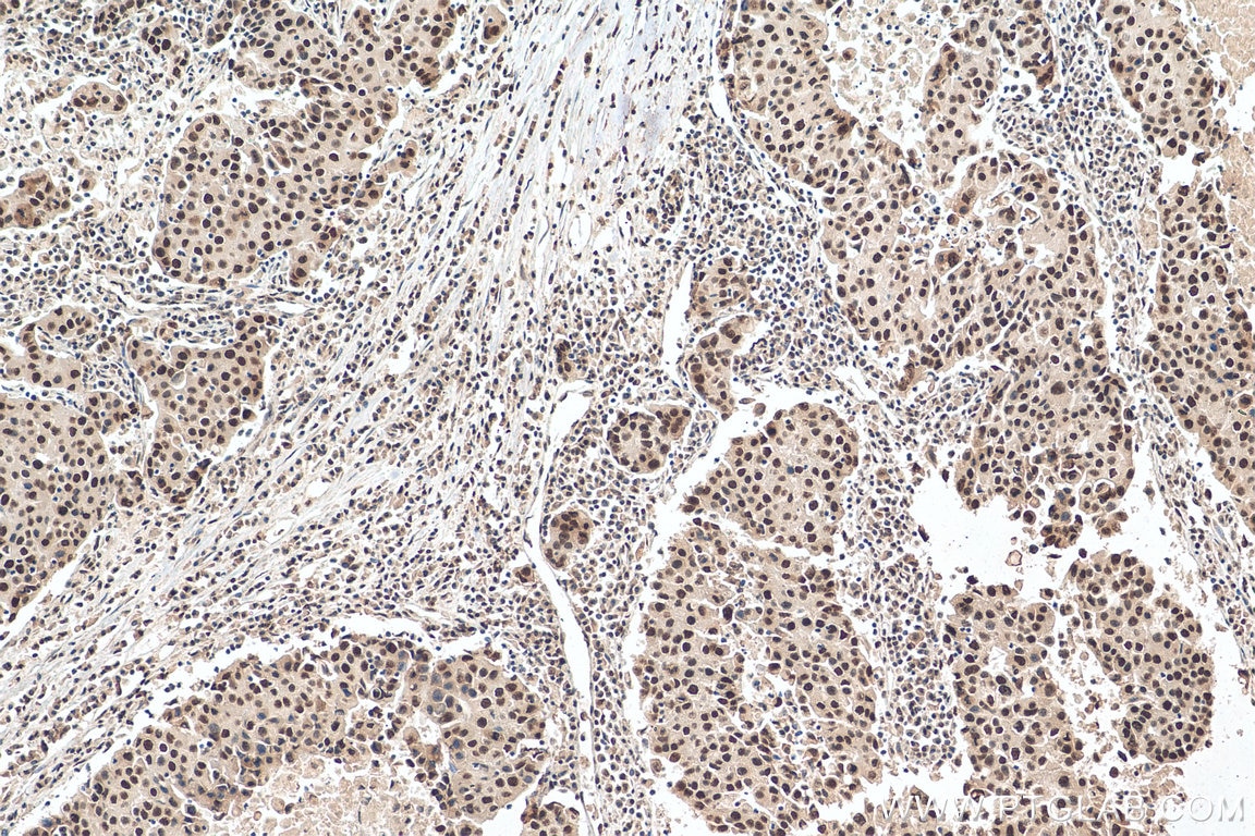 Immunohistochemistry (IHC) staining of human breast cancer tissue using SFRS7 Polyclonal antibody (11044-1-AP)