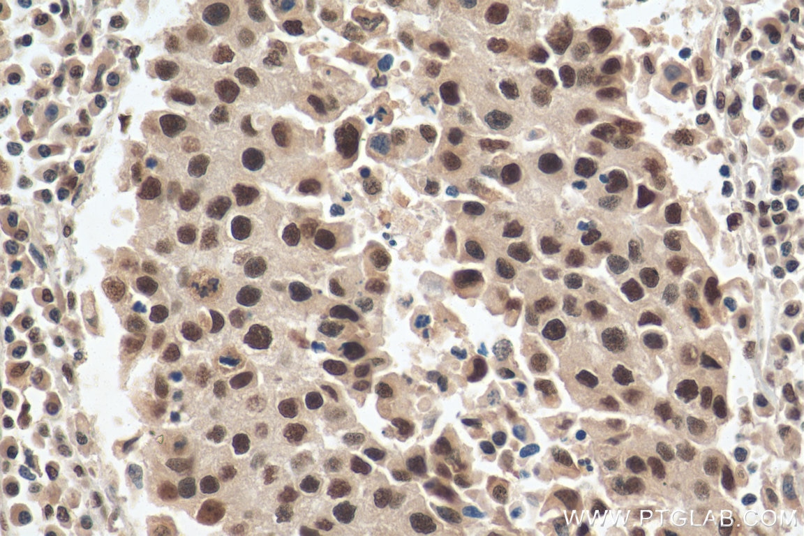 Immunohistochemistry (IHC) staining of human breast cancer tissue using SFRS7 Polyclonal antibody (11044-1-AP)