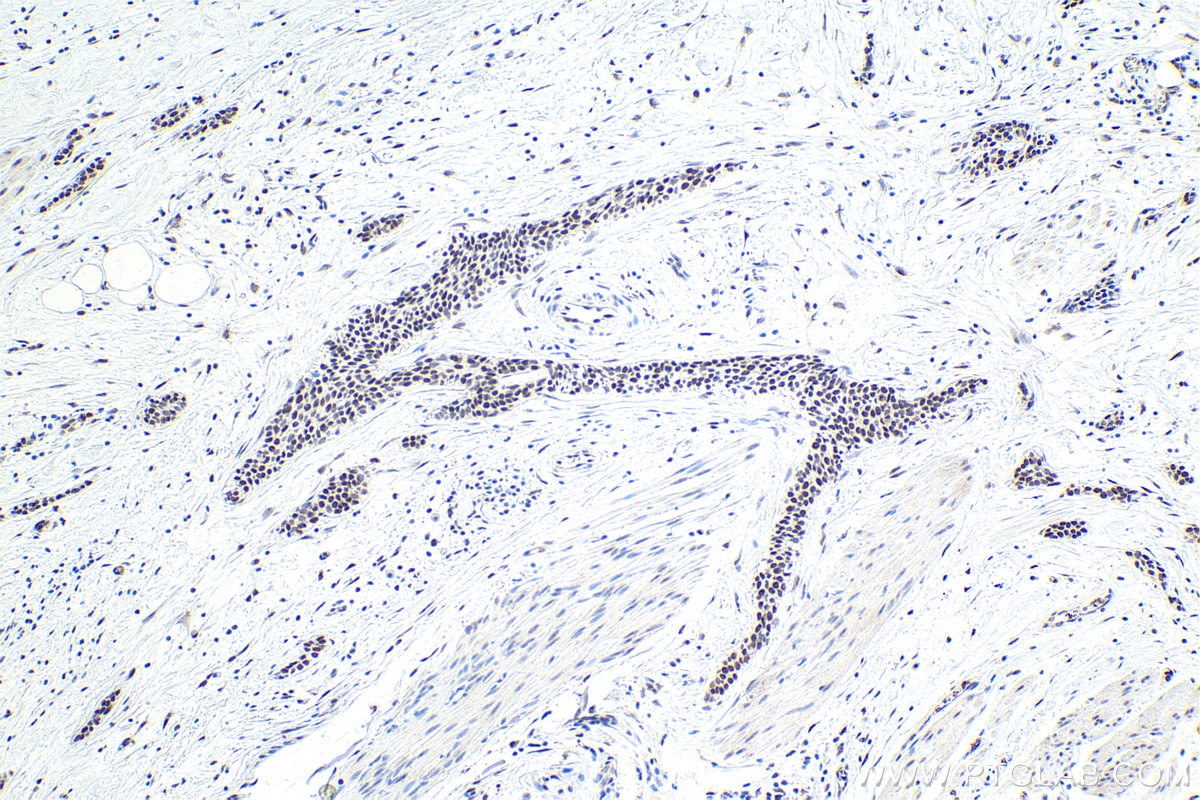 Immunohistochemistry (IHC) staining of human urothelial carcinoma tissue using SFRS9 Polyclonal antibody (17926-1-AP)