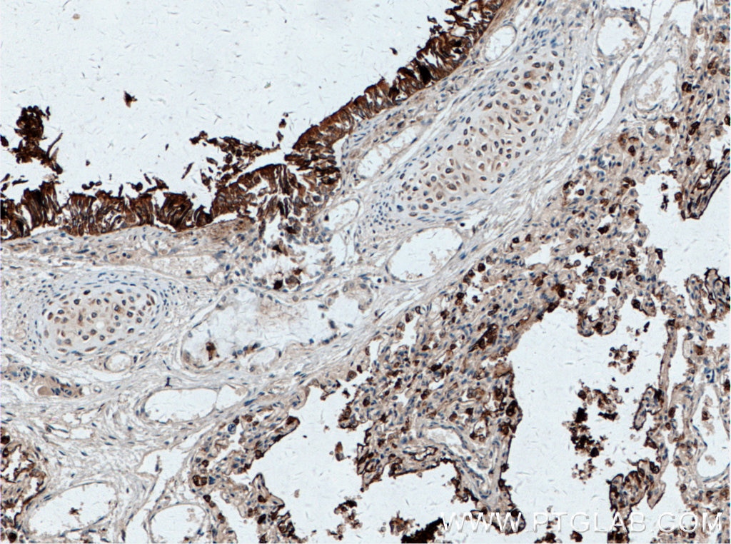 Immunohistochemistry (IHC) staining of human lung tissue using Surfactant Protein A Polyclonal antibody (11850-1-AP)