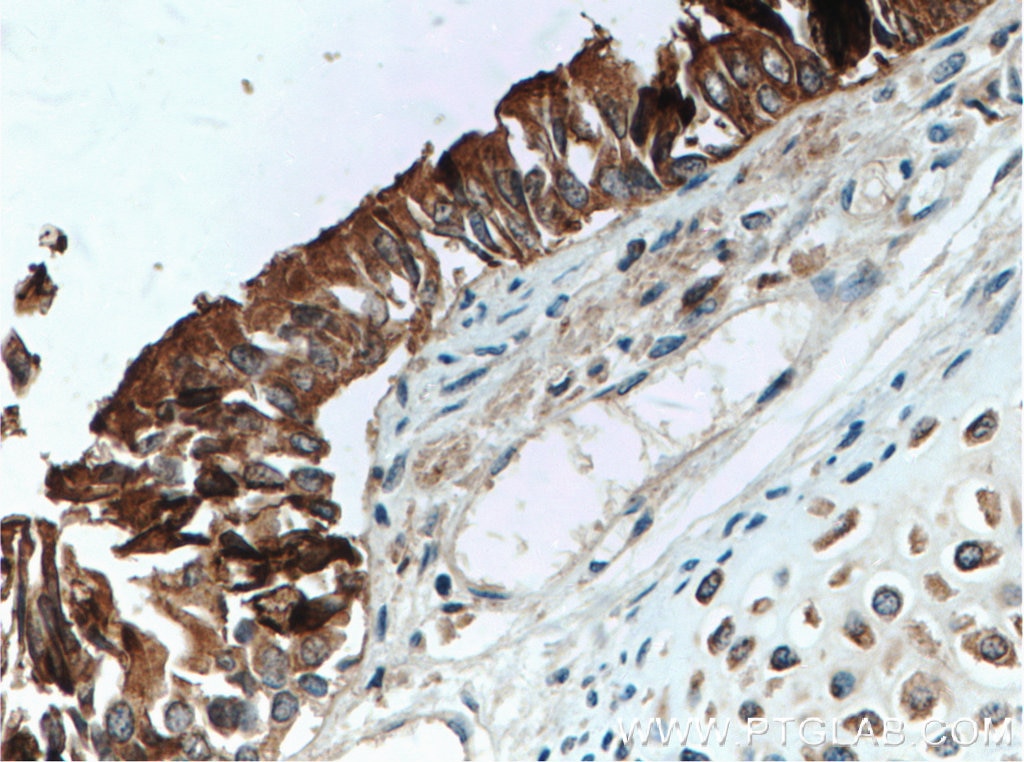 Immunohistochemistry (IHC) staining of human lung tissue using Surfactant Protein A Polyclonal antibody (11850-1-AP)